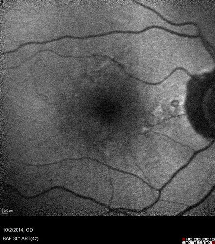 Non-exudative wet AMD right eye (treatment naive quiescent)
82 year old man.  ICG shows CNVM in the right eye.  This stayed quiet for 3 years and then started leaking and responded well to Avastin.

