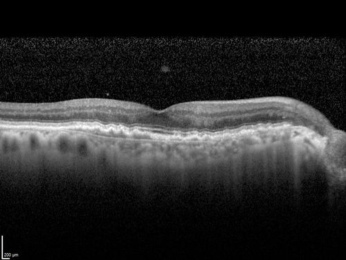 Non-exudative wet AMD right eye (treatment naive quiescent)
82 year old man.  ICG shows CNVM in the right eye.  This stayed quiet for 3 years and then started leaking and responded well to Avastin.
