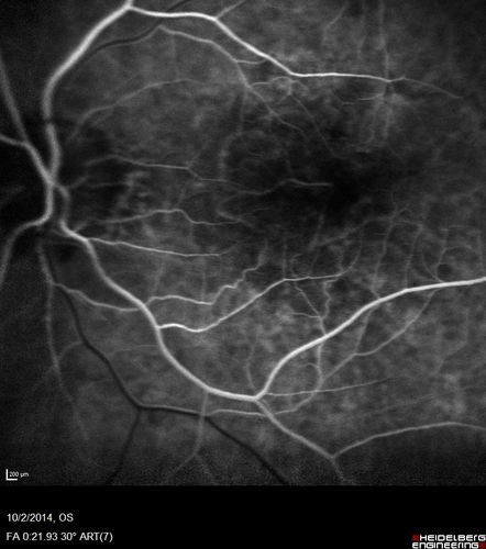 Non-exudative wet AMD right eye (treatment naive quiescent)
82 year old man.  ICG shows CNVM in the right eye.  This stayed quiet for 3 years and then started leaking and responded well to Avastin.

