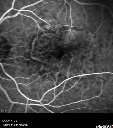 Non-exudative wet AMD right eye (treatment naive quiescent)
82 year old man.  ICG shows CNVM in the right eye.  This stayed quiet for 3 years and then started leaking and responded well to Avastin.
