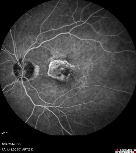 Non-exudative wet AMD right eye (treatment naive quiescent)
82 year old man.  ICG shows CNVM in the right eye.  This stayed quiet for 3 years and then started leaking and responded well to Avastin.

