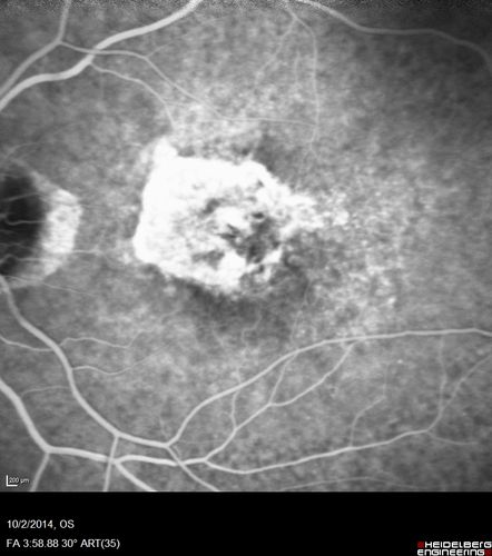 Non-exudative wet AMD right eye (treatment naive quiescent)
82 year old man.  ICG shows CNVM in the right eye.  This stayed quiet for 3 years and then started leaking and responded well to Avastin.
