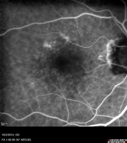 Non-exudative wet AMD right eye (treatment naive quiescent)
82 year old man.  ICG shows CNVM in the right eye.  This stayed quiet for 3 years and then started leaking and responded well to Avastin.
