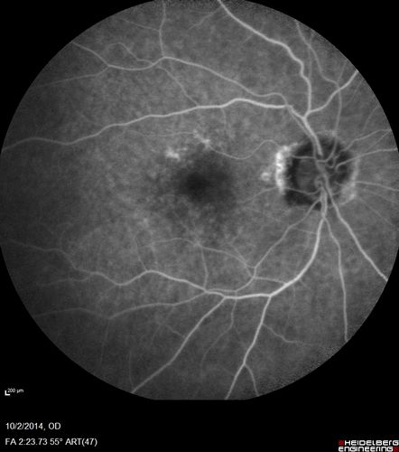 Non-exudative wet AMD right eye (treatment naive quiescent)
82 year old man.  ICG shows CNVM in the right eye.  This stayed quiet for 3 years and then started leaking and responded well to Avastin.
