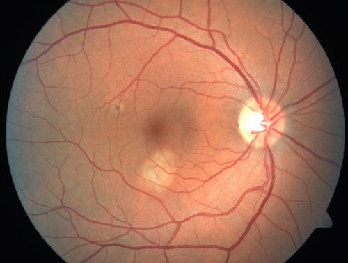 Choroidal Neovascular Membrane - Multifocal Scars - PIC vs MFC vs OHS 
