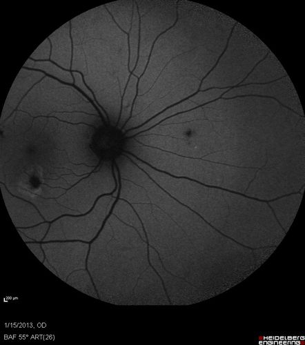 Choroidal Neovascular Membrane - Multifocal Scars - PIC vs MFC vs OHS 

