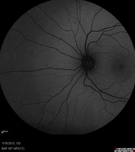 Choroidal Neovascular Membrane - Multifocal Scars - PIC vs MFC vs OHS 
