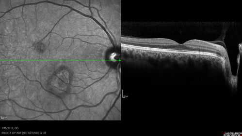 Choroidal Neovascular Membrane - Multifocal Scars - PIC vs MFC vs OHS 
