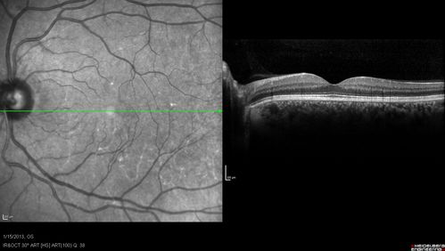 Choroidal Neovascular Membrane - Multifocal Scars - PIC vs MFC vs OHS 
