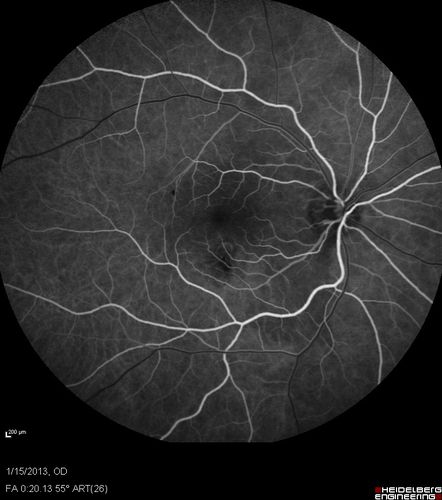Choroidal Neovascular Membrane - Multifocal Scars - PIC vs MFC vs OHS 
