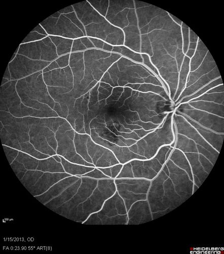 Choroidal Neovascular Membrane - Multifocal Scars - PIC vs MFC vs OHS 
