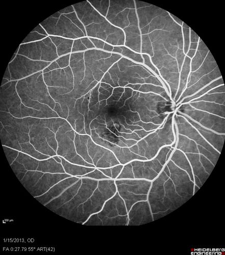 Choroidal Neovascular Membrane - Multifocal Scars - PIC vs MFC vs OHS 
