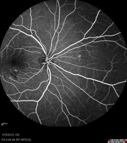 Choroidal Neovascular Membrane - Multifocal Scars - PIC vs MFC vs OHS 
