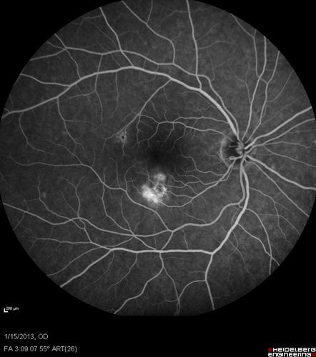 Choroidal Neovascular Membrane - Multifocal Scars - PIC vs MFC vs OHS 

