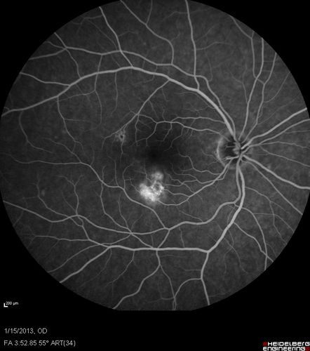 Choroidal Neovascular Membrane - Multifocal Scars - PIC vs MFC vs OHS 
