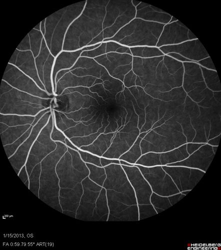 Choroidal Neovascular Membrane - Multifocal Scars - PIC vs MFC vs OHS 
