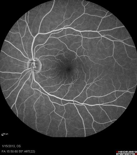 Choroidal Neovascular Membrane - Multifocal Scars - PIC vs MFC vs OHS 
