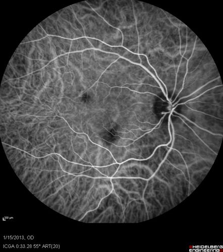Choroidal Neovascular Membrane - Multifocal Scars - PIC vs MFC vs OHS 

