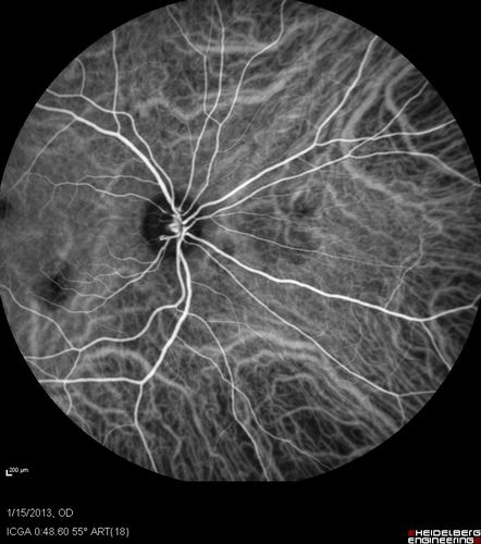 Choroidal Neovascular Membrane - Multifocal Scars - PIC vs MFC vs OHS 

