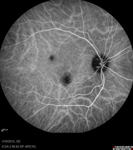 Choroidal Neovascular Membrane - Multifocal Scars - PIC vs MFC vs OHS 

