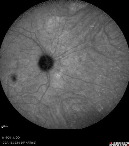 Choroidal Neovascular Membrane - Multifocal Scars - PIC vs MFC vs OHS 
