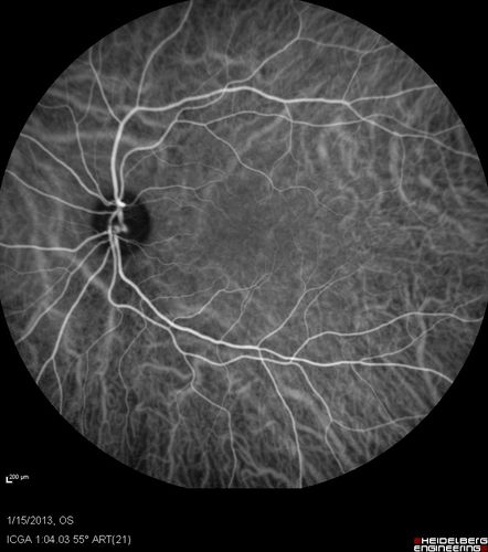 Choroidal Neovascular Membrane - Multifocal Scars - PIC vs MFC vs OHS 
