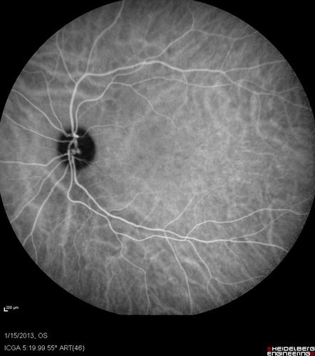 Choroidal Neovascular Membrane - Multifocal Scars - PIC vs MFC vs OHS 
