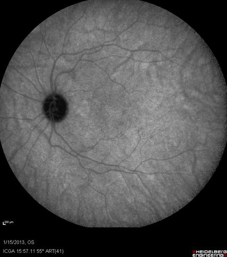Choroidal Neovascular Membrane - Multifocal Scars - PIC vs MFC vs OHS 
