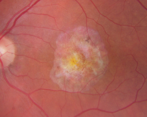 Macular Degeneration - Choroidal Laser Left eye - New Subfoveal CNVM left eye - Did well with Avastin
69-year-old woman new vision loss right eye and old macular scar left eye. OD 20/40, OS 20/200
