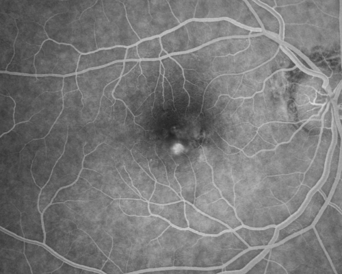 Macular Degeneration - Choroidal Laser Left eye - New Subfoveal CNVM left eye - Did well with Avastin
69-year-old woman new vision loss right eye and old macular scar left eye. OD 20/40, OS 20/200
