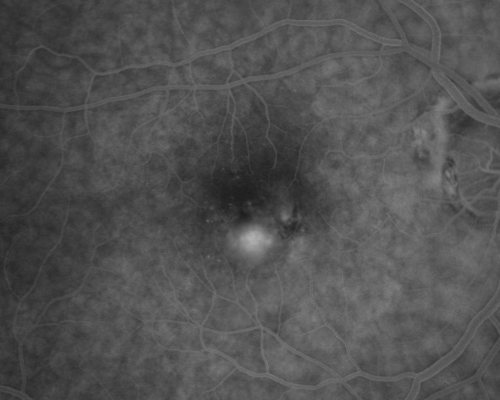 Macular Degeneration - Choroidal Laser Left eye - New Subfoveal CNVM left eye - Did well with Avastin
69-year-old woman new vision loss right eye and old macular scar left eye. OD 20/40, OS 20/200
