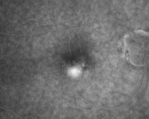 Macular Degeneration - Choroidal Laser Left eye - New Subfoveal CNVM left eye - Did well with Avastin
69-year-old woman new vision loss right eye and old macular scar left eye. OD 20/40, OS 20/200
