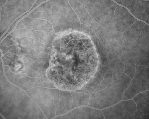 Macular Degeneration - Choroidal Laser Left eye - New Subfoveal CNVM left eye - Did well with Avastin
69-year-old woman new vision loss right eye and old macular scar left eye. OD 20/40, OS 20/200

