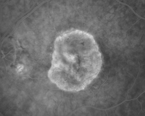 Macular Degeneration - Choroidal Laser Left eye - New Subfoveal CNVM left eye - Did well with Avastin
69-year-old woman new vision loss right eye and old macular scar left eye. OD 20/40, OS 20/200
