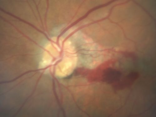 Choroidal Neovascular Membrane - Optic Disc Drusen - Hemorrhage (Coumadin) 
82-year-old man with decreased vision in the left eye over about the last six to 12 months.  He is also on Coumadin.    OD 20/20, OS 20/80
