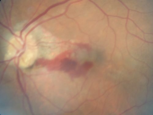 Choroidal Neovascular Membrane - Optic Disc Drusen - Hemorrhage (Coumadin) 
82-year-old man with decreased vision in the left eye over about the last six to 12 months.  He is also on Coumadin.    OD 20/20, OS 20/80
