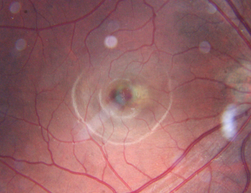 Macular Hemorrahge and Probable CNVM Right eye for 2 weeks VA 20/400 - 20 Year old
20-year-old man noticed vision loss in the right eye about two weeks ago and if anything it seems to be getting worse. He is a high myope.  VISUAL ACUITY:  OD 20/400
