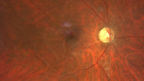 Coats Plus Syndrome - Cerebroretinal microangiopathy with calcifications and cysts (CRMCC)
38 year old female CTC1 positive with Coats Plus Syndrome.  This case was published https://pmc.ncbi.nlm.nih.gov/articles/PMC10649444/

