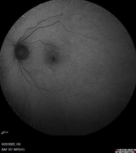 Coats Plus Syndrome - Cerebroretinal microangiopathy with calcifications and cysts (CRMCC)
38 year old female CTC1 positive with Coats Plus Syndrome.  This case was published https://pmc.ncbi.nlm.nih.gov/articles/PMC10649444/
