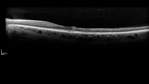 Coats Plus Syndrome - Cerebroretinal microangiopathy with calcifications and cysts (CRMCC)
38 year old female CTC1 positive with Coats Plus Syndrome.  This case was published https://pmc.ncbi.nlm.nih.gov/articles/PMC10649444/

