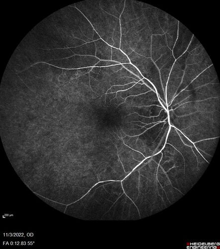 Coats Plus Syndrome - Cerebroretinal microangiopathy with calcifications and cysts (CRMCC)
38 year old female CTC1 positive with Coats Plus Syndrome.  This case was published https://pmc.ncbi.nlm.nih.gov/articles/PMC10649444/
