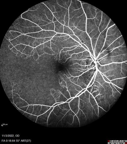Coats Plus Syndrome - Cerebroretinal microangiopathy with calcifications and cysts (CRMCC)
38 year old female CTC1 positive with Coats Plus Syndrome.  This case was published https://pmc.ncbi.nlm.nih.gov/articles/PMC10649444/
