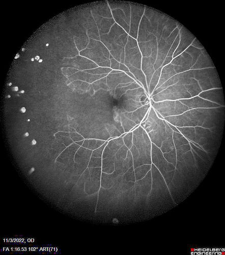 Coats Plus Syndrome - Cerebroretinal microangiopathy with calcifications and cysts (CRMCC)
38 year old female CTC1 positive with Coats Plus Syndrome.  This case was published https://pmc.ncbi.nlm.nih.gov/articles/PMC10649444/
