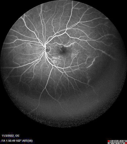 Coats Plus Syndrome - Cerebroretinal microangiopathy with calcifications and cysts (CRMCC)
38 year old female CTC1 positive with Coats Plus Syndrome.  This case was published https://pmc.ncbi.nlm.nih.gov/articles/PMC10649444/
