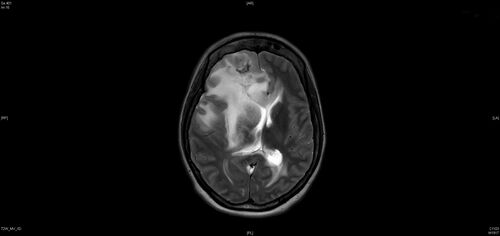 Coats Plus Syndrome - Cerebroretinal microangiopathy with calcifications and cysts (CRMCC)
38 year old female CTC1 positive with Coats Plus Syndrome.  This case was published https://pmc.ncbi.nlm.nih.gov/articles/PMC10649444/
