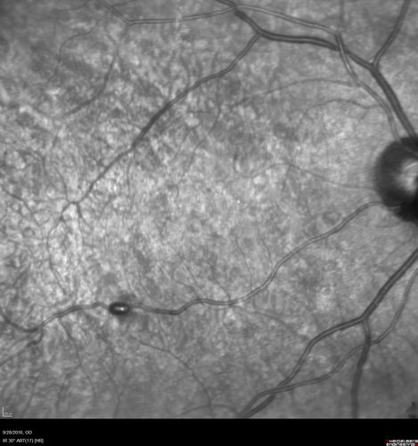 Macular Macroaneurysm with Coats Disease
61 year old man with increased leakage from macular macroaneurysm right eye
