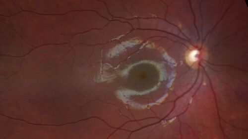 Coats' Disease - 8-year-old boy - Asymptomatic
Normal vision - Lesion picked up on examination
