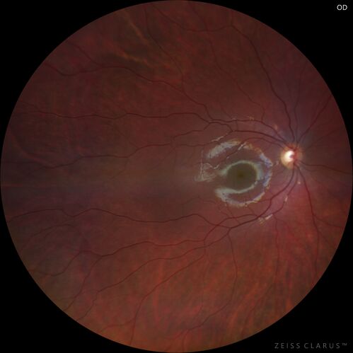 Coats' Disease - 8-year-old boy - Asymptomatic
Normal vision - Lesion picked up on examination

