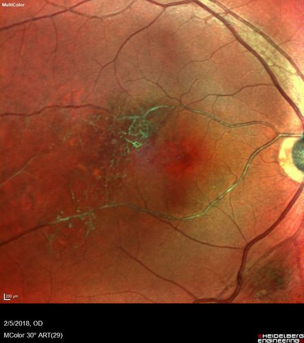 Coats Disease - Parafoveal Telangiectasis Type I - Right Eye
67 year old man with long history of vision loss in the right eye.  Previously treated with laser, avastin.  VA 20/200.
