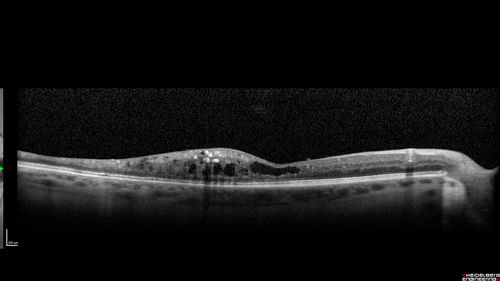 Coats Disease - Parafoveal Telangiectasis Type I - Right Eye
67 year old man with long history of vision loss in the right eye.  Previously treated with laser, avastin.  VA 20/200.
